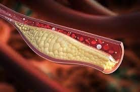  Cholesterol – Types, Prevention, Tests